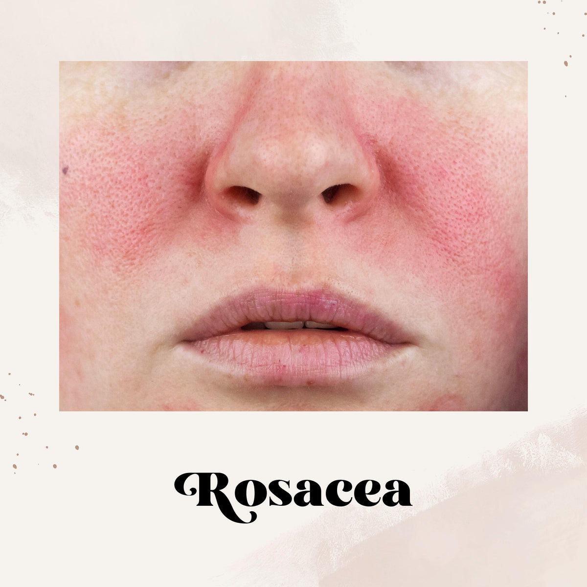 Rosacea – Persōn & Covey, Inc.